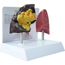 Smoker's Lung vs Healthy Lung Comparative Model - Life Size Anatomical Display for Medical Education, Respiratory Health Study Tool with Pathological Features, PVC Structure