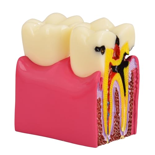 Ultrassist Dental Tooth Decay Model, Dental Caries Demonstration Model, Tooth Anatomy Teaching Model for Dental Education, Patient Explanation and Oral Health Classroom Teaching